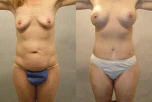 Before and After Image