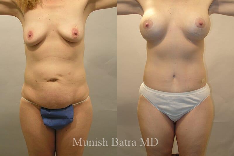 Before and After Image