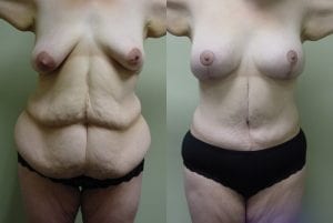 Before and After Image