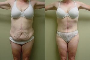 Before and After Image