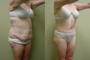 Before and After Image