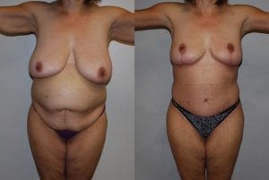 Before and After Image