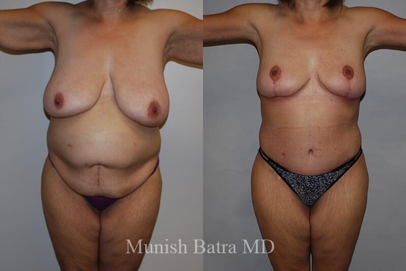Before and After Image