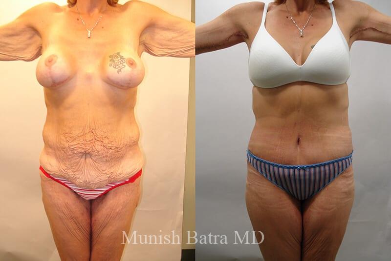 Before and After Image