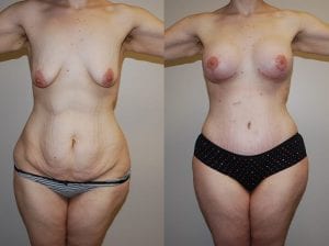 Before and After Image