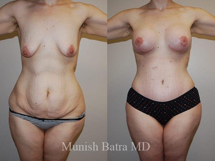 GBRX Abdominoplasty Reconstruction Patient 35 front.