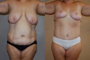Before and After Image