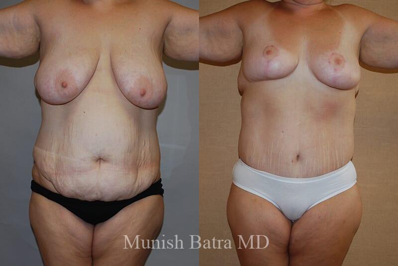 Before and After Image