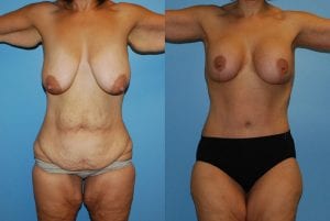 Before and After Image