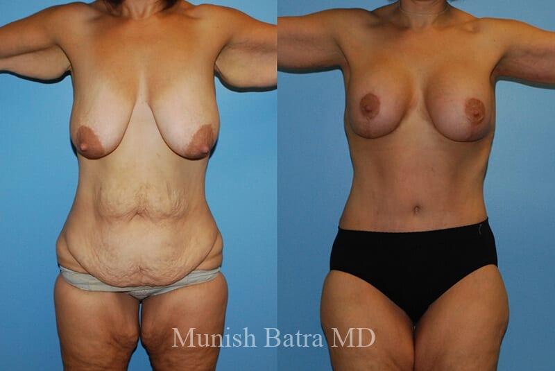 Before and After Image