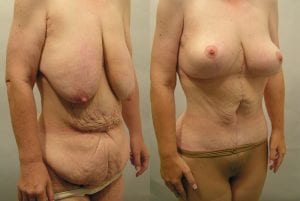 Before and After Image