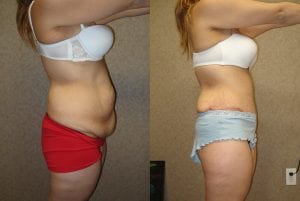 Before and After Image
