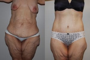 Before and After Image