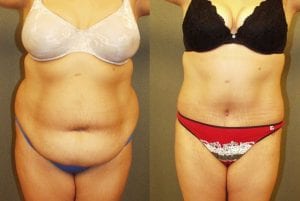 Before and After Image