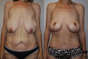 Before and After Image