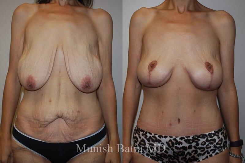 Before and After Image