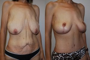 Before and After Image