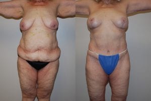 Before and After Image