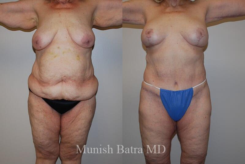 Before and After Image