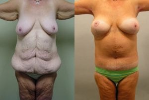 Before and After Image