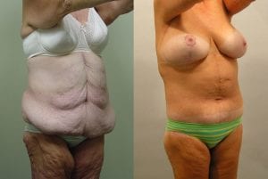 Before and After Image