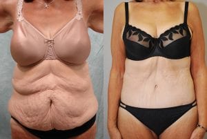 Before and After Image