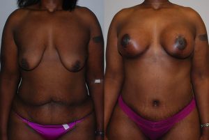 Before and After Image