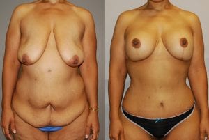 Before and After Image