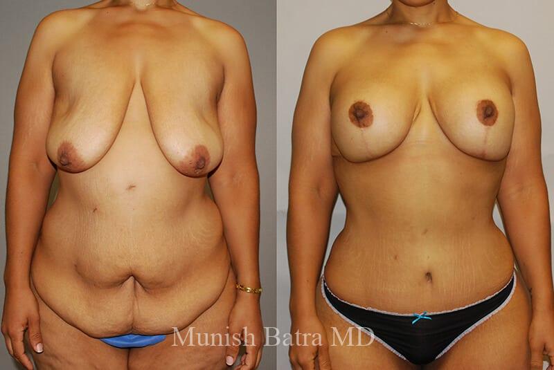 Before and After Image