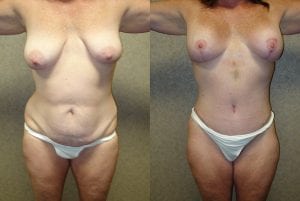 Before and After Image
