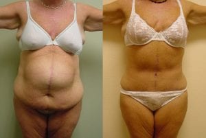 Before and After Image