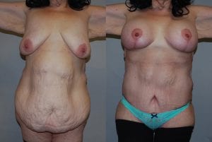 Before and After Image