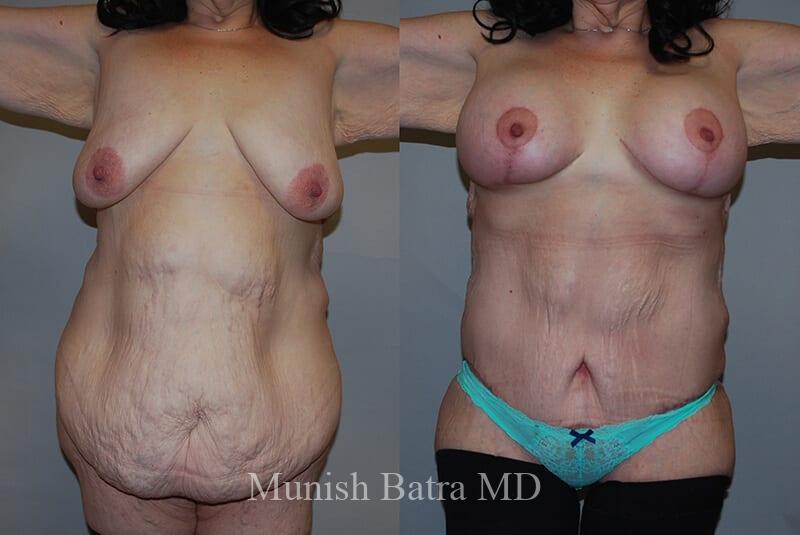 Before and After Image