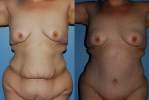 Before and After Image