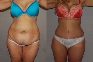 Before and After Image