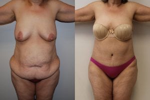 Before and After Image
