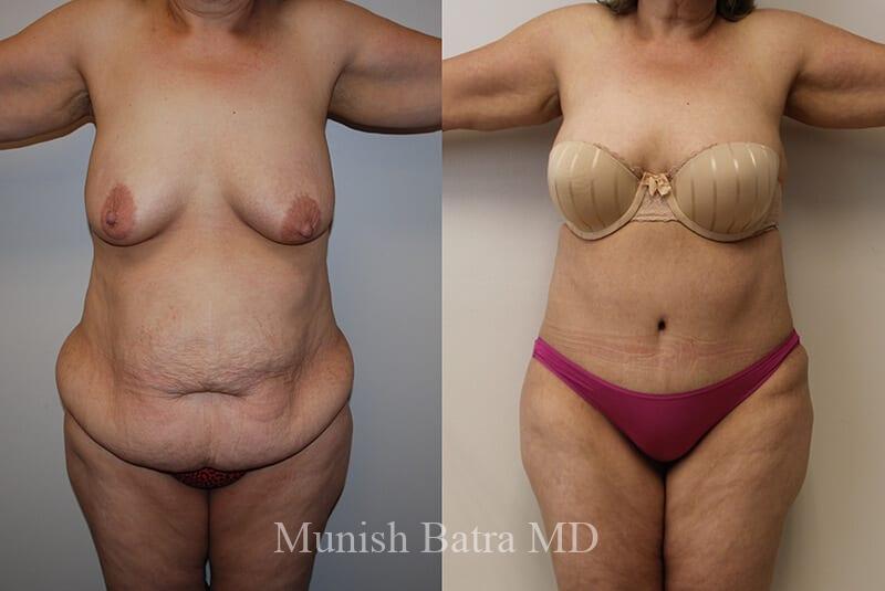 Before and After Image