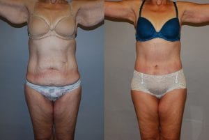 Before and After Image