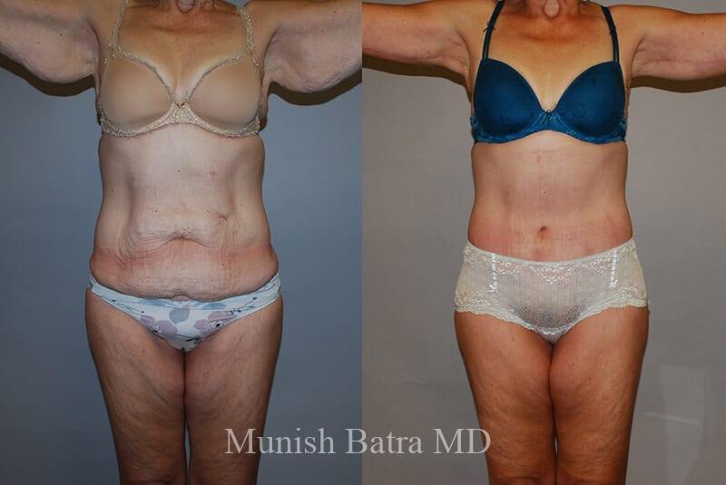 Before and After Image