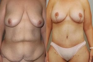 Before and After Image