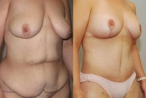 Before and After Image
