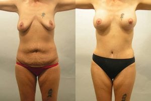 Before and After Image