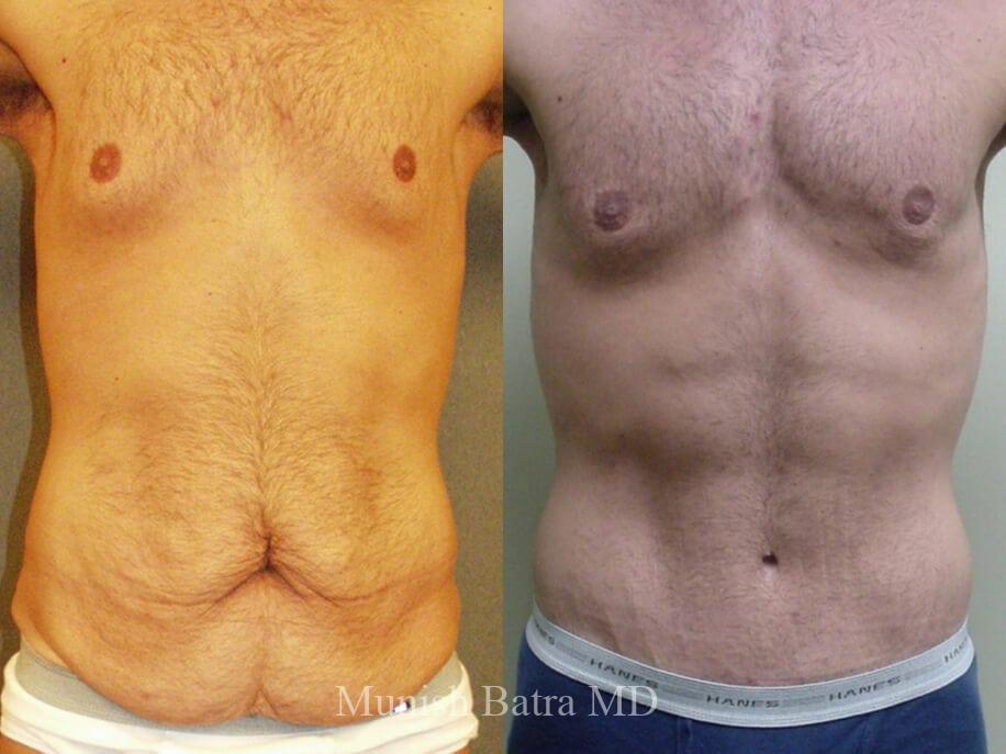 Tummy Tuck and Liposuction on Male Weight Loss Patient