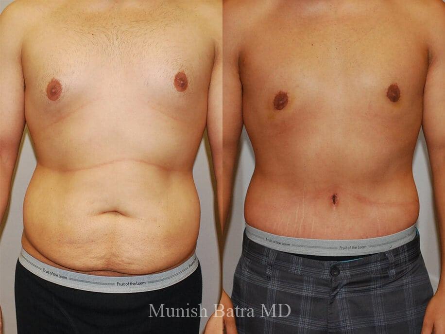 Before & After Male Abdominoplasty Photos - Coastal Plastic Surgeons