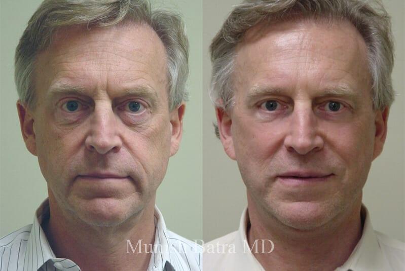 Before and After Image