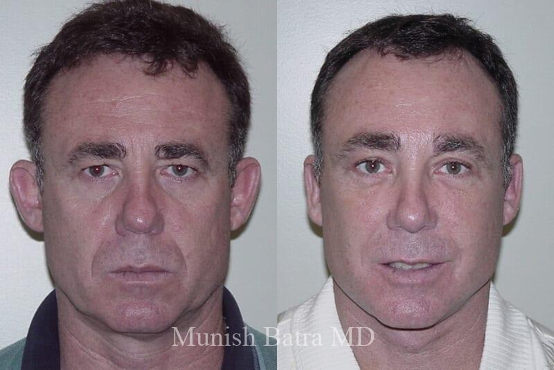 Before and After Image