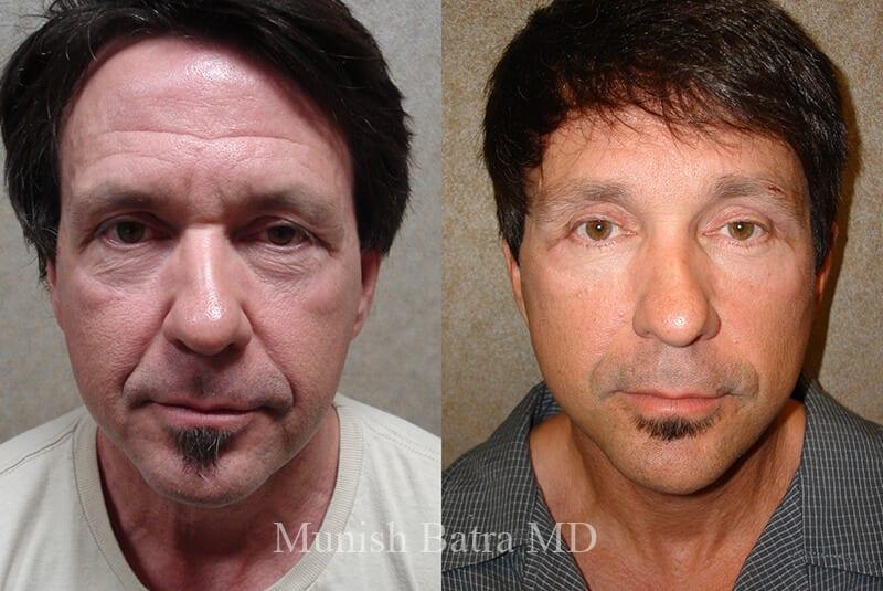 Before and After Image