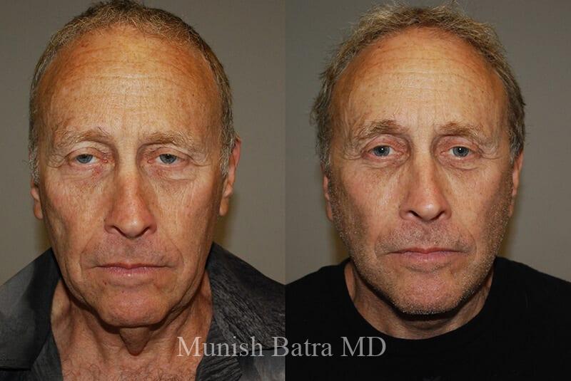 Before and After Image