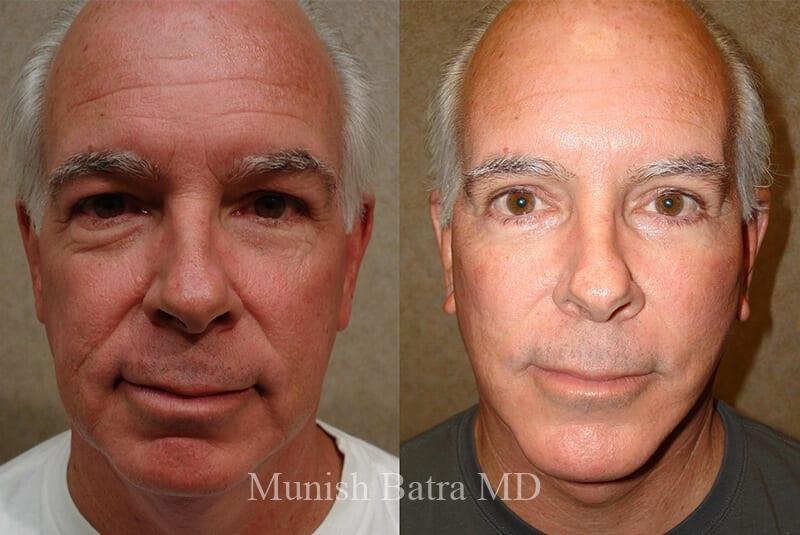 Before and After Image