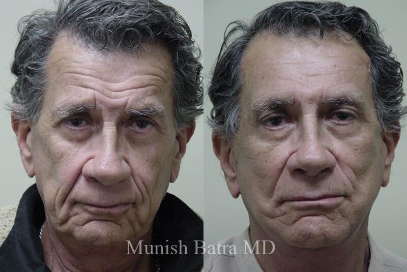 Before and After Image